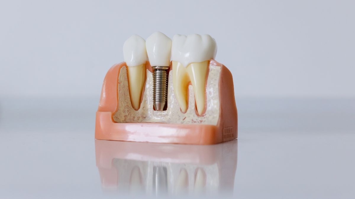 Lire la suite à propos de l’article Remboursement implant dentaire : quelle est la meilleure mutuelle ?